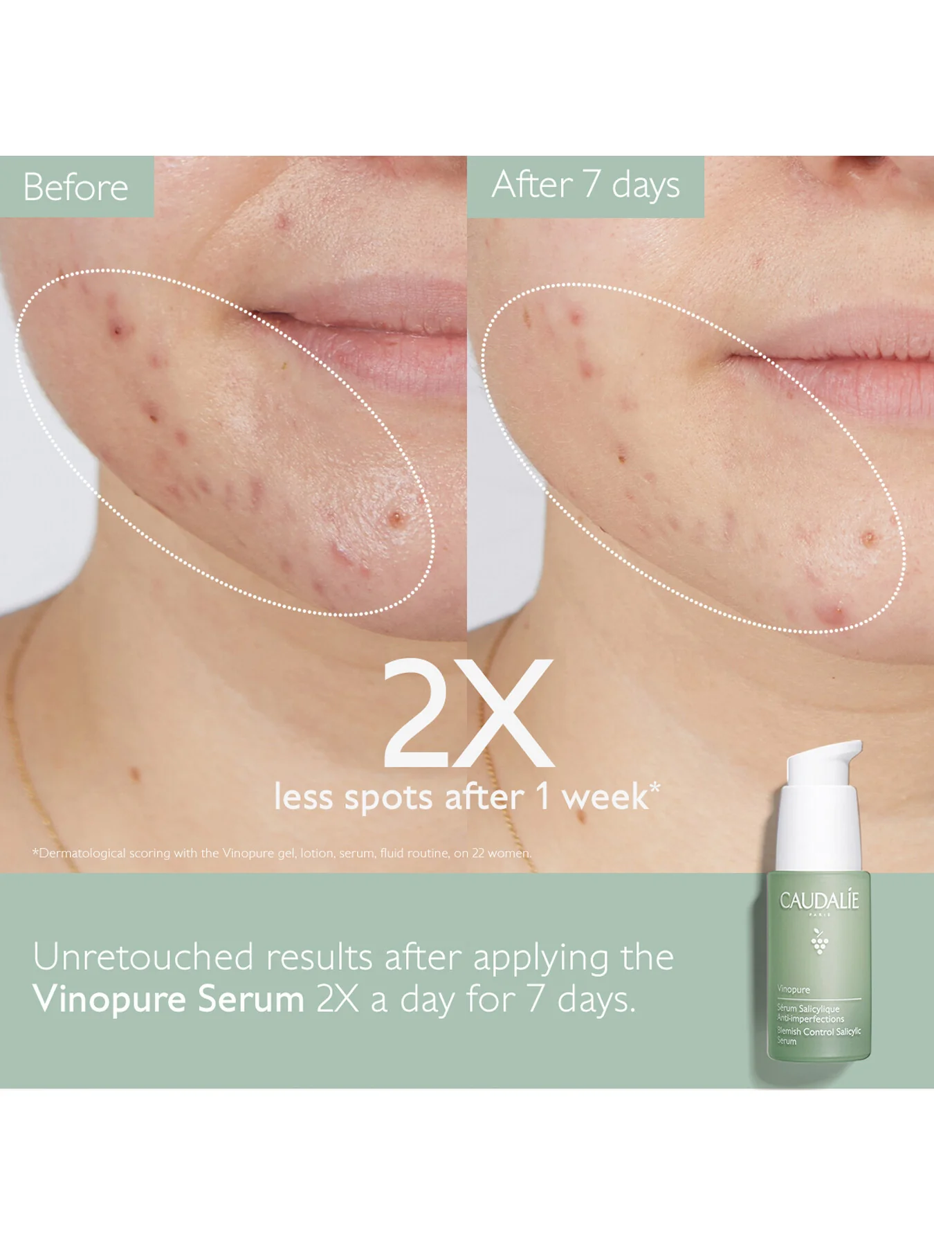 Vinopure Blemish Control Salicylic Serum 30ml - Image 2