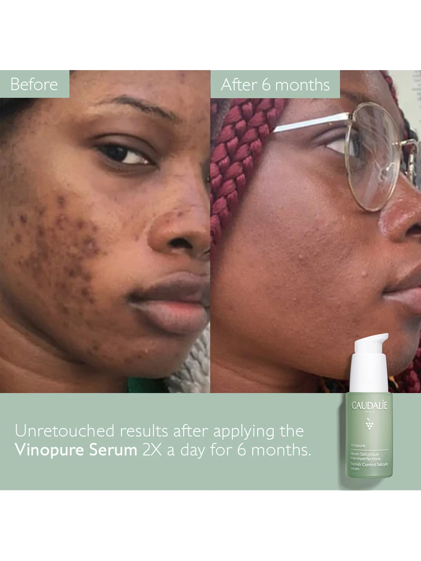 Vinopure Blemish Control Salicylic Serum 30ml - Image 5